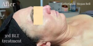 BLT Facial