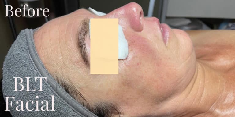 Before Image: BLT Facial -