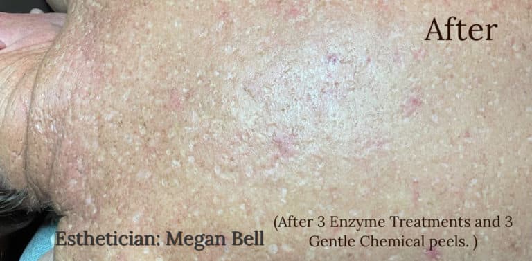 After Image: Back Facials - front