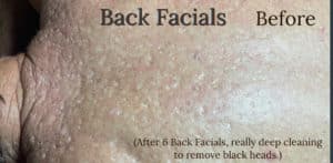 Back Facials