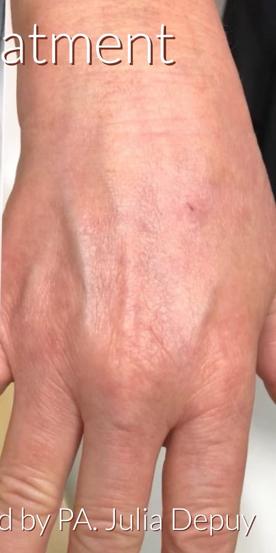 After Image: IPL Treatment - front