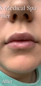 Lip Filler