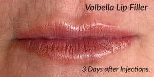 Volbella Lip Filler