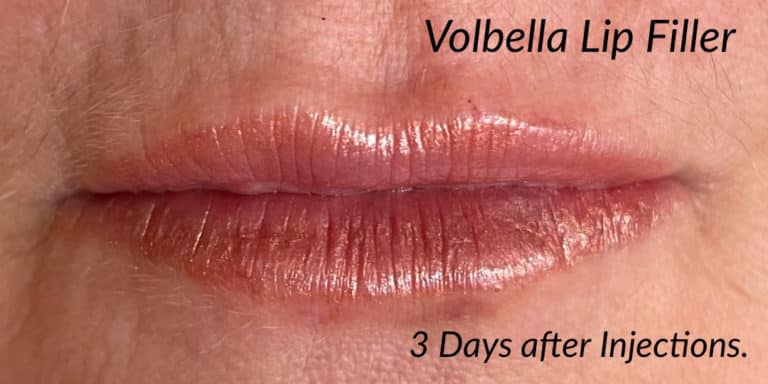 After Image: Volbella Lip Filler - front